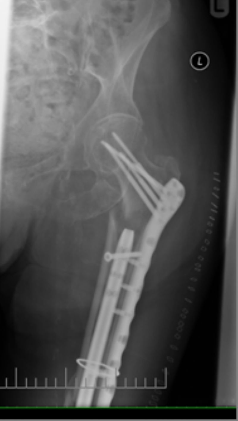 Zimmer NCB Periarticular Proximal Femoral Plate (Implant 4262)